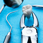 Удаление зуба