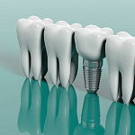 Имплантация зубов