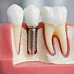 Костная пластика и имплантация